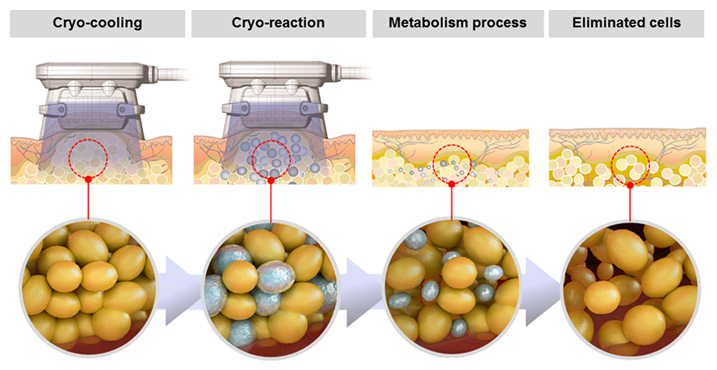 fat freeze cryolipolysis treatment